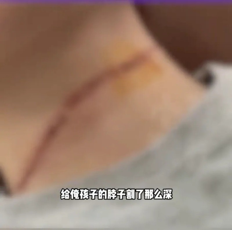 又到风筝季，2天3起“割喉”!17岁男孩缝21针