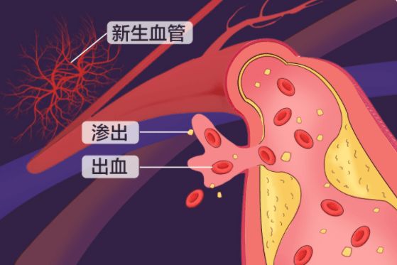 【吉林市爱尔眼科医院】 眼底检查护糖友：别让“糖网”偷走光明